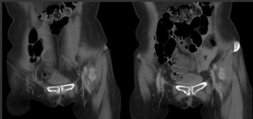 Figure 2 for case Neuritis Ossificans